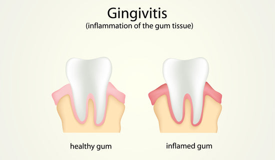 What Is Gingivitis?
