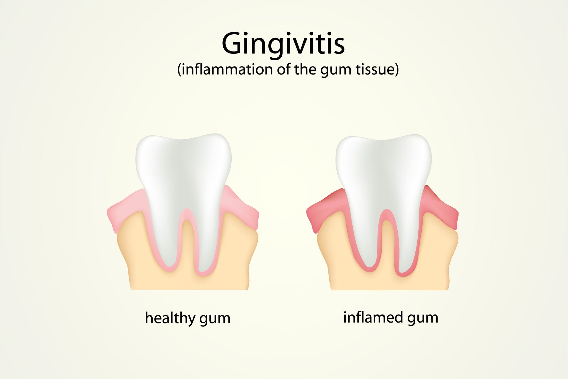 Comparative illustration showing healthy gum vs inflamed gum (gingivitis) around a tooth.