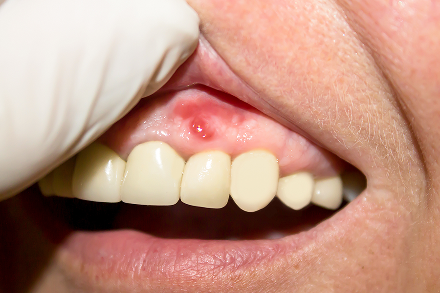 Periodontal (Gum) Disease: The Hidden Threat to Your Wallet and Your Health