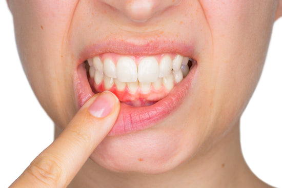 Bleeding Gums - Causes, Symptoms and Treatment